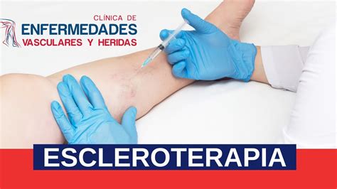 ¿qué Es Y En Qué Consta El Tratamiento De Escleroterapia Que Trata Las