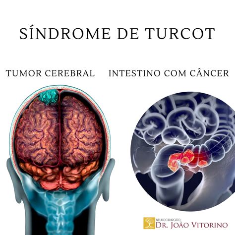 Síndrome de Turcot - Neurocirurgião em São Paulo - Especialista em Tumores Cerebrais