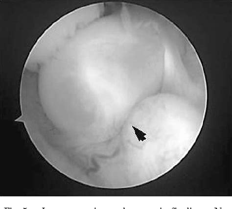 Figure From Meniscal Ganglion Cysts Without Accompanying Meniscal