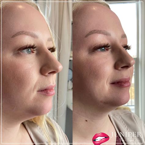 Chin Enhancement 1 Juniper Face Figure
