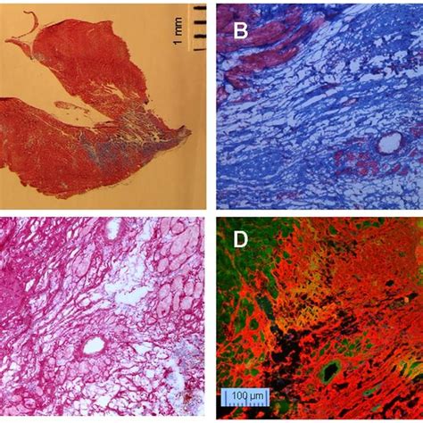 Staining Of Fibrosis In Infarcted Area A And B Masson S Trichrome C