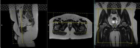 MRI Sports Hernia Scan | Sports Hernia MRI Protocol and Planning