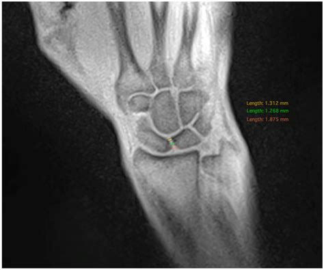 Diagnostics Free Full Text Measurement Of Scapholunate Joint Space