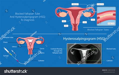 Hysterosalpingogram Hsg Test Blocked Fallopian Tubes 库存矢量图（免版税