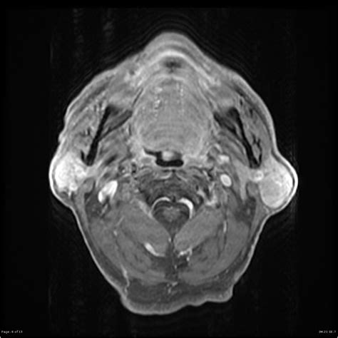 Tumor De Warthin