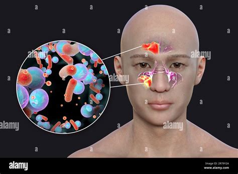 Sinusitis Inflammation Of Paranasal Cavities 3d Illustration Showing