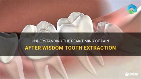 Understanding The Peak Timing Of Pain After Wisdom Tooth Extraction