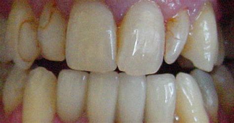 Porcelain Veneers San Jose, Dental Veneers, Teeth Veneers San Jose, CA