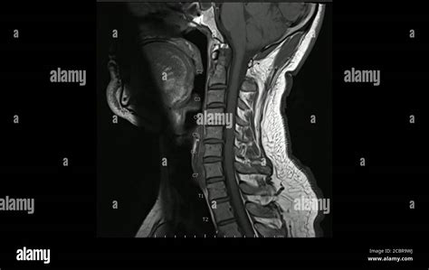 Magnetic Resonance Images Of Cervical Spine Sagittal T1 Weighted Images