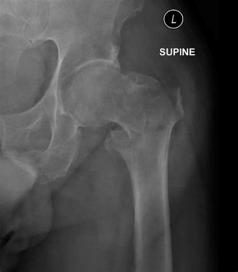 Acute Comminuted Intertrochanteric Hip Fracture Jetem