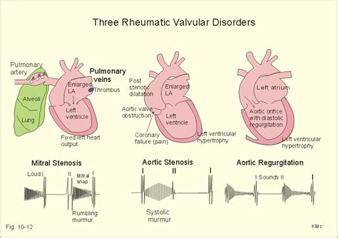 Russell's Blog: aortic stenosis murmur location