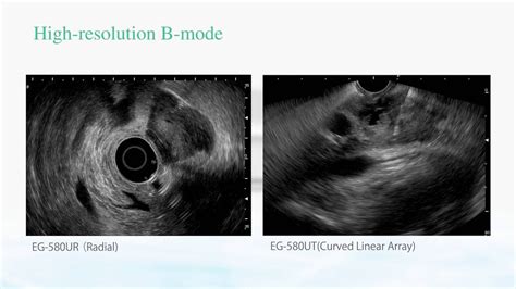 Fujifilm SU1 Endoscopic Ultrasound System YouTube