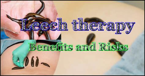 Leech Therapy Health Benefits And Risks Daddydontblog