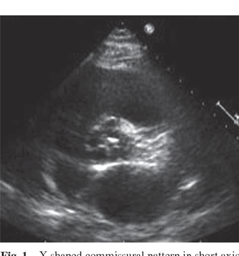 Figure 1 From Quadricuspid Aortic Valve With Ascending Aortic Aneurysm