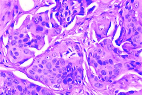 Moderately Differentiated Squamous Cell Carcinoma H P E Hande 10x