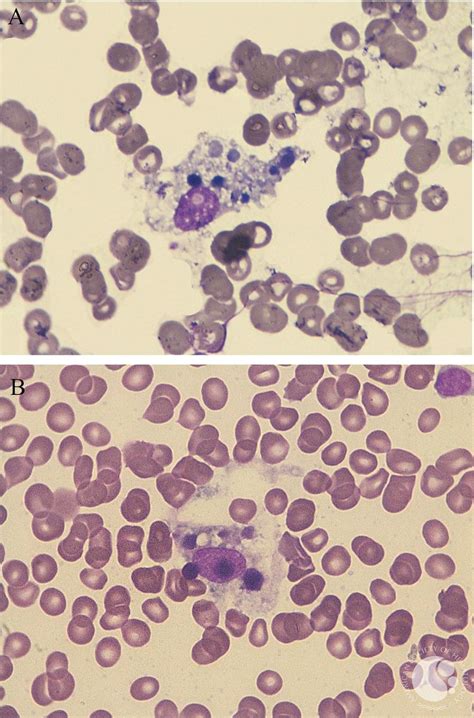 Vacuolated Macrophage With Digested Cells Bone Marrow Aspirate 100x