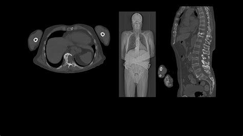 Precision In Oncological Imaging Siemens Healthineers Ireland