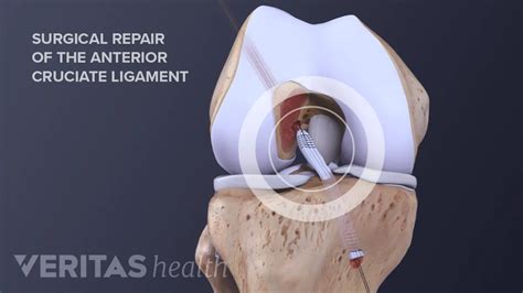 Patellar Tendon Graft