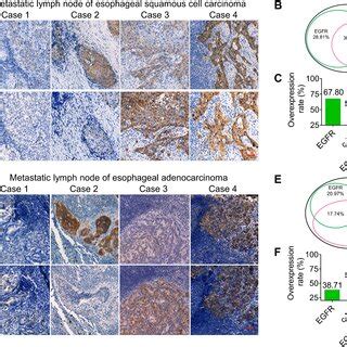 Complementary Expression Of Egfr And C Met In Primary Escc And Eac