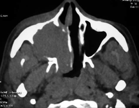 Axial Section Showing A Right Maxillary Sinus Tumor Causing Destruction