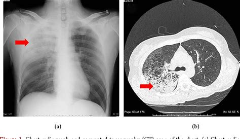 Figure 1 from Pseudomonas aeruginosa Community Acquired Pneumonia with ...