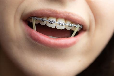 Para qué sirven las gomas de los brackets Martínez Avilés