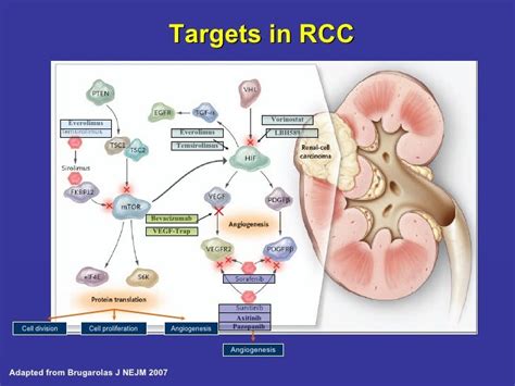 Renal Cell Carcinoma A New Standard Of Care