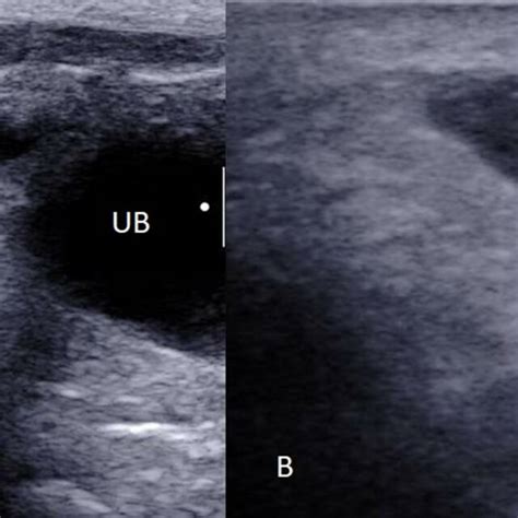 Usg Image In Transverse Orientation Shows A Right Testis White