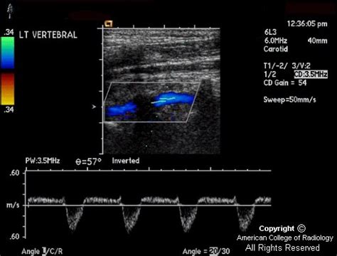 Neuroradiology On the Net: Subclavian steal syndrome (SSS)