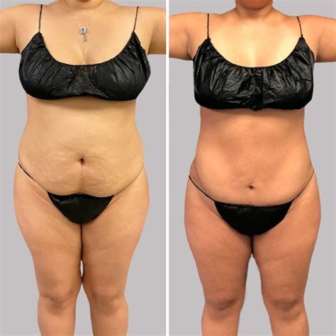 Liposuction Before And After Photos What You Can Really Expect Say Surgeons The Healthy