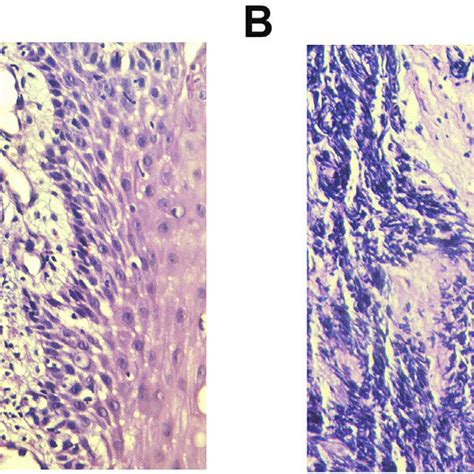 A Small Round To Oval Tumor Cells Arranged In Cords Or Nests H E