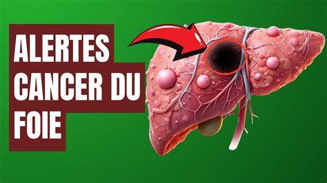 🚨 Alerte Cancer 5 Signaux Critiques Du Cancer Du Foie à Détecter à Temps Fact24h Youtube