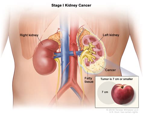 Renal Cell Cancer Treatment Pdq® Pdq Cancer Information Summaries Ncbi Bookshelf