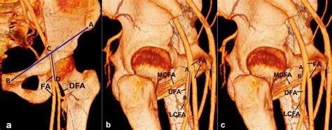 Three Dimensional Volume Rendering Ct Reconstruction Showing The