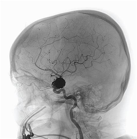 How Successful Is Aneurysm Coiling Sterling Bobbitt