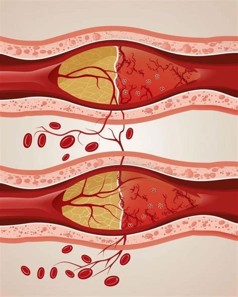 Pay Attention 8 Warning Signs When Your Arteries Are Clogged