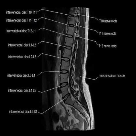 Ct Dorsal Spine Test Price In Delhi Ganesh Diagnostic