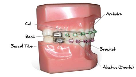 How Do Braces Work Health Row