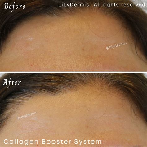 Collagen Booster System Lilydermis Calgary Alberta Canada