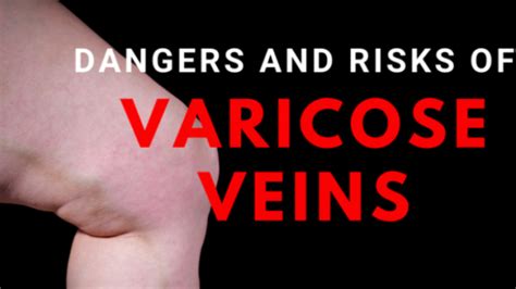 Hidden Dangers Of Varicose Veins Vein Medicine