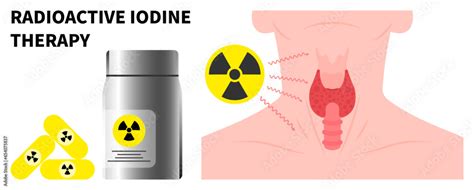 Neck Swelling With Radioactive Iodine To Treat Graves And Hashimoto S