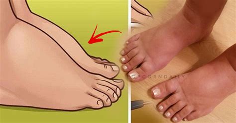 The 8 Reasons Why Your Health Maybe In Danger If You Have Swollen Feet