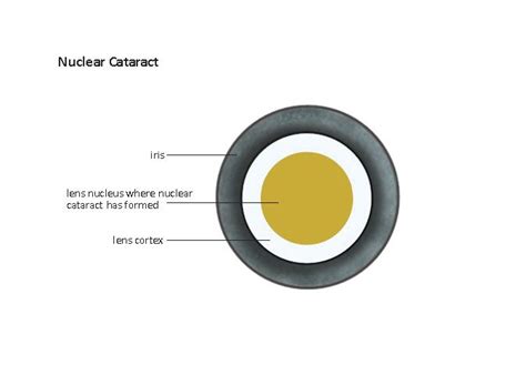 Types of Cataracts | Cataract Surgery Information