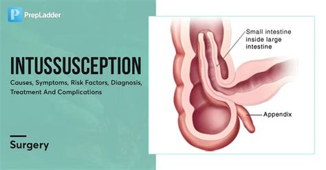 Intussusception