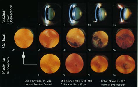 Cataract Type Grade 1 Grade 2 Grade 3 Grade 4 Nuclear Mild Moderate