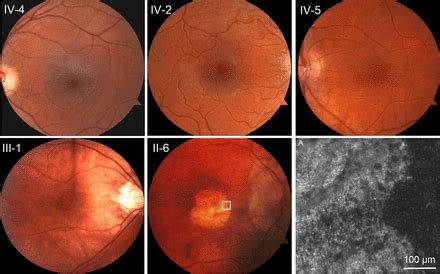 Phenotypic Diversity In Autosomal Dominant Cone Rod Dystrophy