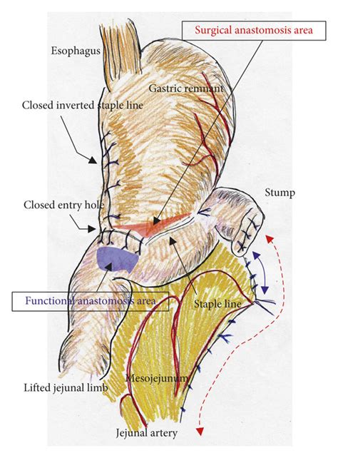 Overlap anastomosis involves linear-stapled reconstruction using an ...