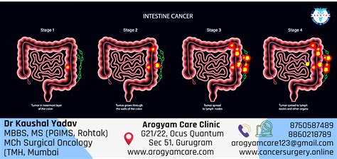 understanding  stages  cancer  detailed overview