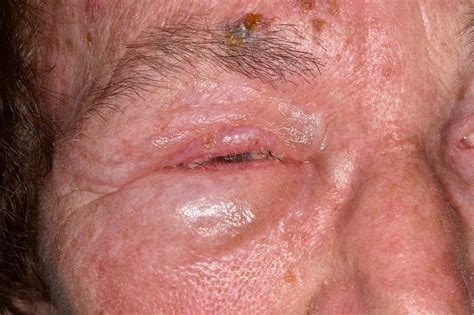 Shingles Rash Affecting Facial Nerve Bild Kaufen 12919408 Science Photo Library