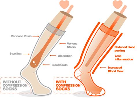 Using Compression Socks For Sprained Ankle Sox Solution Sox Solution